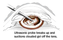 File:CataractSurgeryPic01.jpg