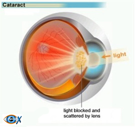 File:Uploadimages_Cataracts.jpg‎